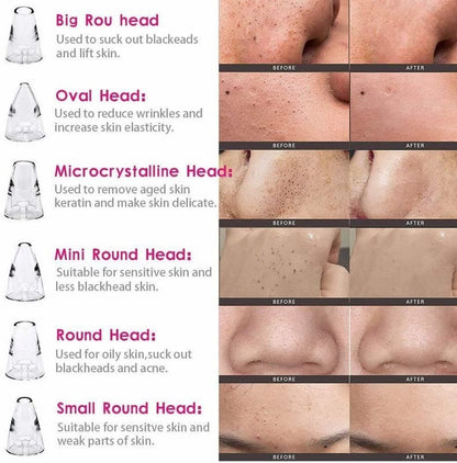 DermaGlow™ 5-in-1 Blackhead Vacuum Pore Cleaner