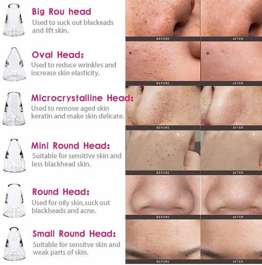 DermaGlow™ 5-in-1 Blackhead Vacuum Pore Cleaner